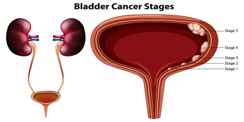 Warning Signs of Bladder Cancer