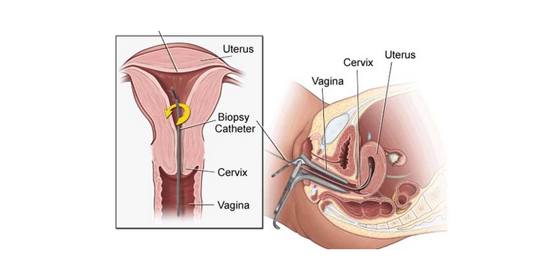 Best Hysteroscopic Endometrial Biopsy Treatment In India