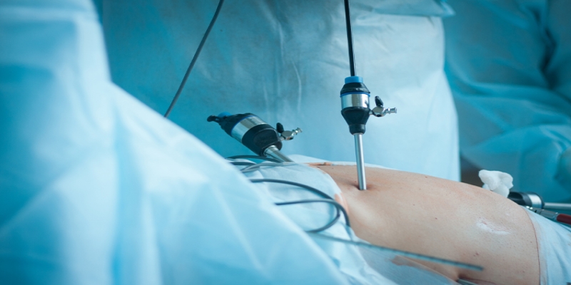 Laser Treatment for Gallbladder Stones: A Comprehensive Overview