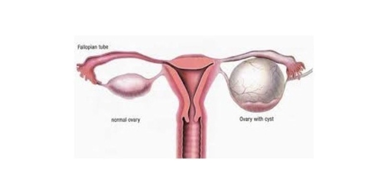 Best Ovarian Cysts Surgery Hospital & Specialist in India - RG