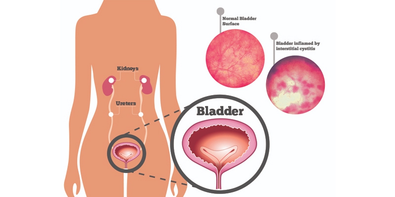 Best Painful Bladder Syndrome Treatment in India – RG Hospital