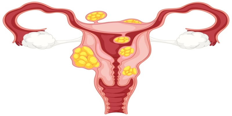 The Ultimate Guide to Uterine Fibroids Treatment: What Every Woman Should Know