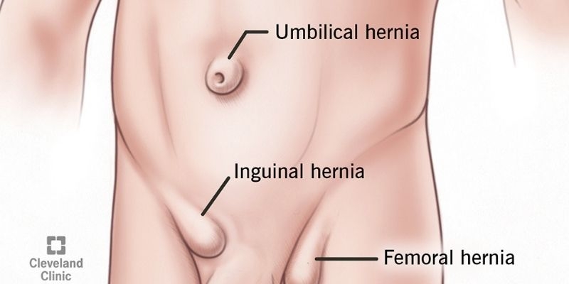 Inguinal hernia: The most common type of hernia in men and women