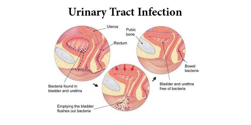 Medicine for Urinary Tract Infection: Antibiotics, Pain Relief