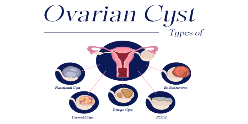 Ovarian Cysts: Types, Symptoms, and Diagnosis