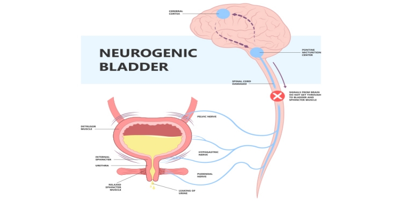 10 Surprising Facts About Neurogenic Bladder That You Need to Know